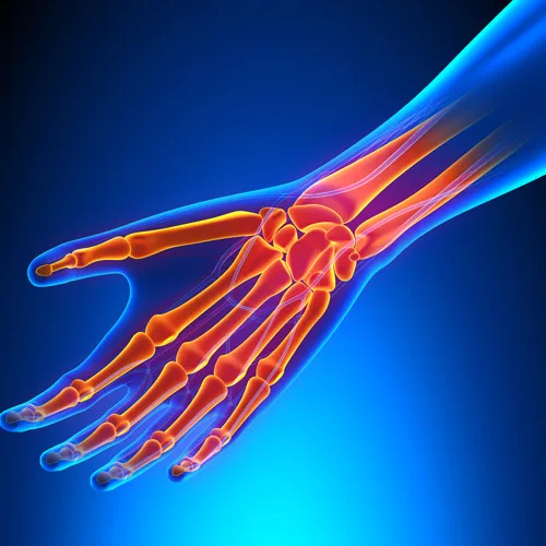 graphic of wrist and hand pain