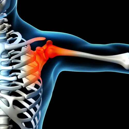 graphic showing shoulder pain